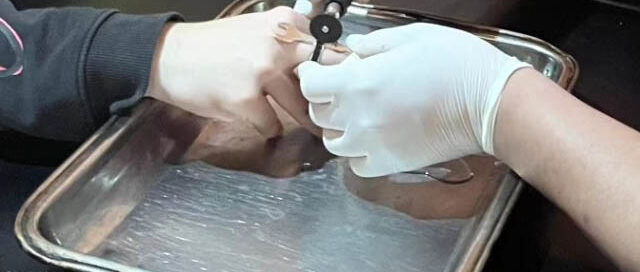 Bomberos de Oberá auxiliaron a un joven que sufría por un anillo que le cortaba la circulación